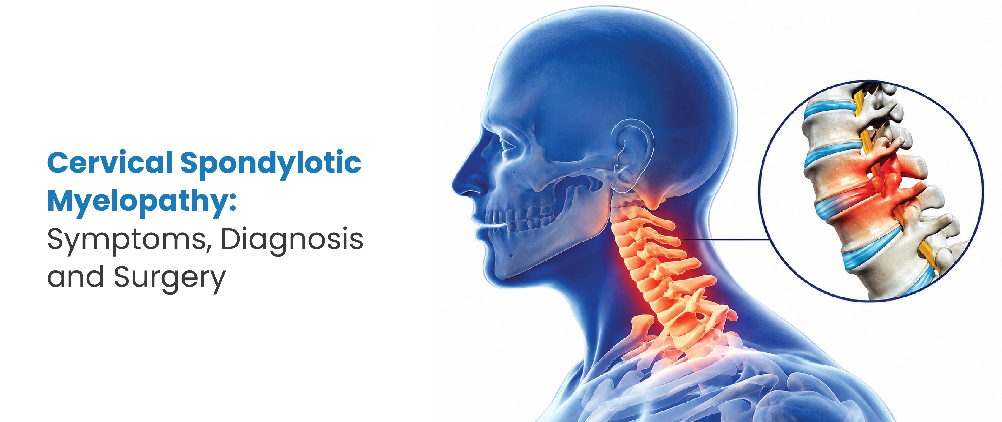 Cervical Spondylotic Myelopathy: Symptoms, Diagnosis & Surgery